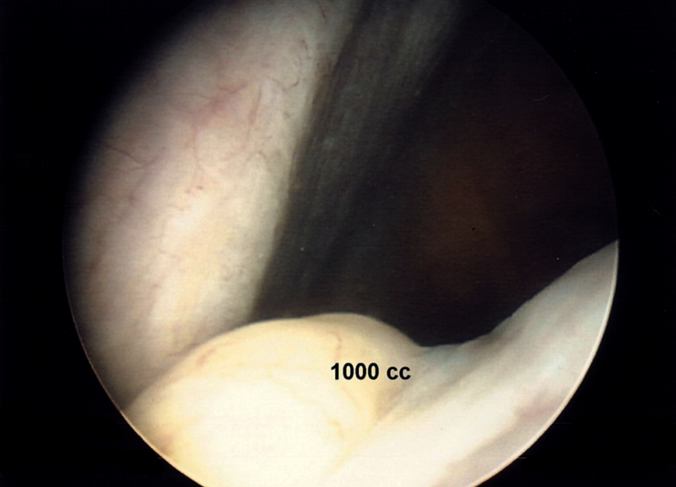 Separation of bowel loops with 1000cc of Adept adhesion reduction solution. High separation is shown